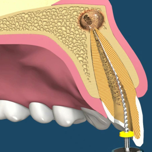 implantologia-studio-donadio-napoli-endodonzia