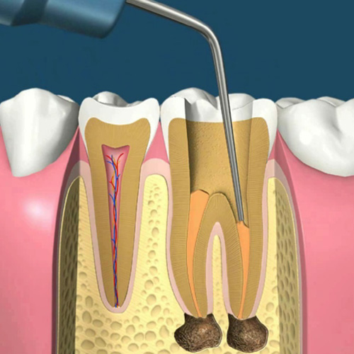 implantologia-studio-donadio-napoli-endodonzia